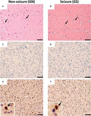 Altered Spontaneous Glutamatergic and GABAergic Activity in the Peritumoral Cortex of Low-Grade Gliomas Presenting With History of Seizures